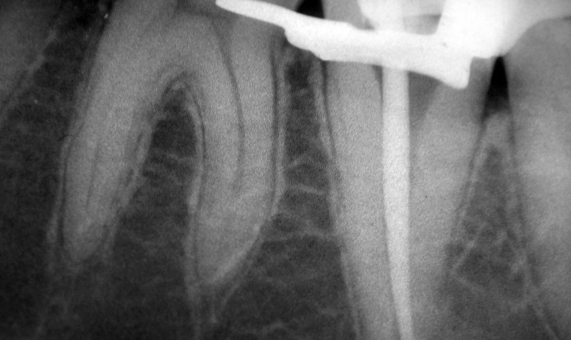 Endodoncia