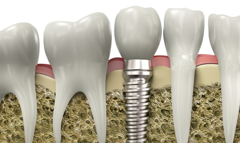 Implantes dentales