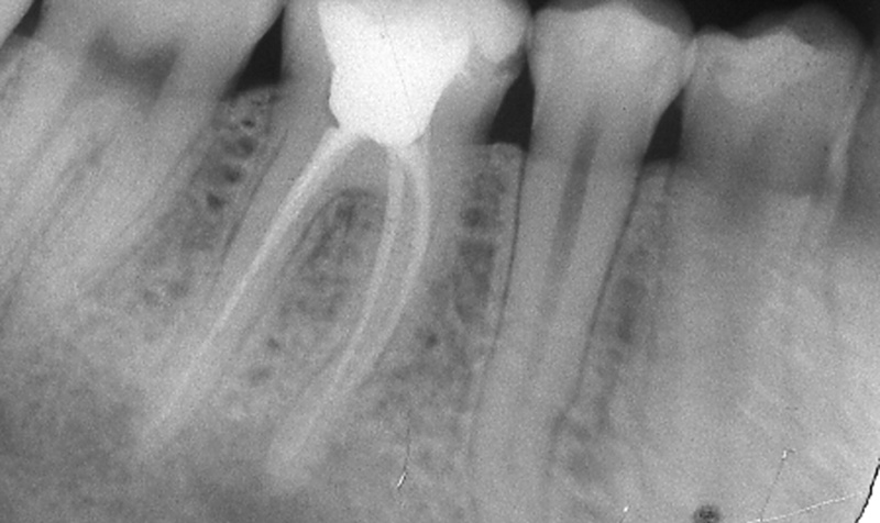 Cirugía periapical